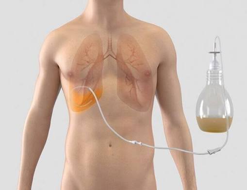 Aspira Pleural Drainage at Home