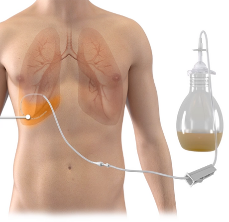 Pleural Drainage