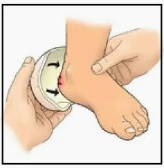 Applying ointment to a wounded heel for at-home medical care and wound relief